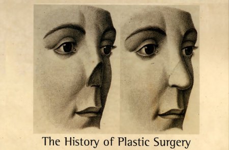 Из истории пластической хирургии.