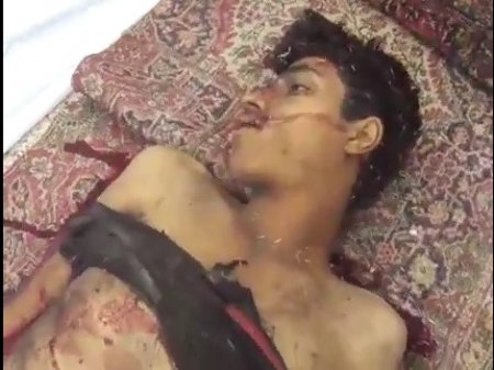Молодой сириец пострадал от артобстрела