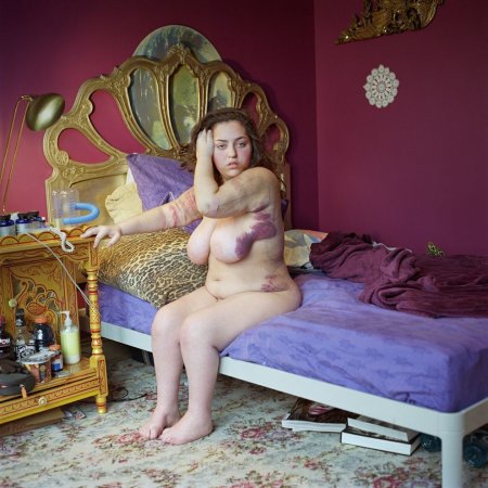 Люди с редкими заболеваниями в серии фотографий Софи Клафтер