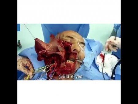 Операция на лице