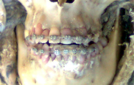 Феномен розовых зубов у мертвеца