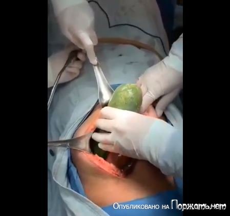 Хирургическое извлечение инородного тела 