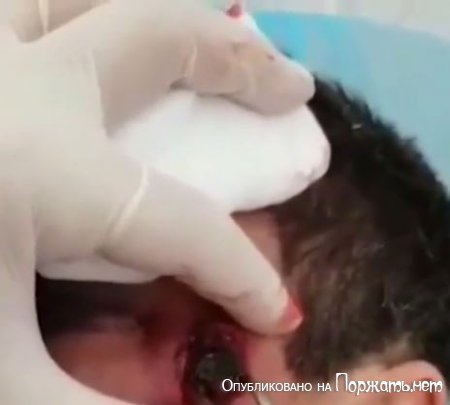 Хирургия после выстрела  в лицо 