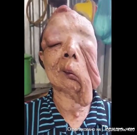 Женщина с опухолью на лице 2