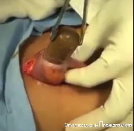 Хирургическое извлечение инородного тела попавшего в кишечник через задницу 